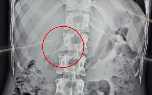 The woman survived after the sewing needle entered the liver