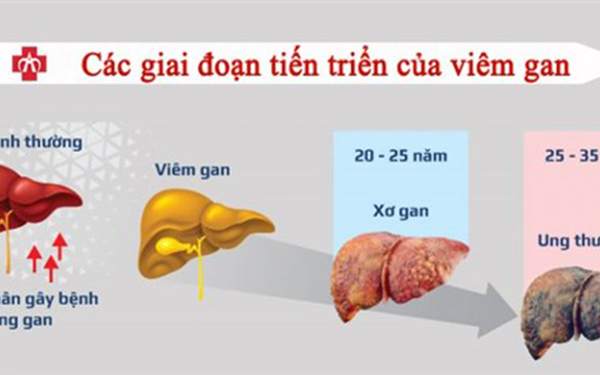 How to prevent liver cancer