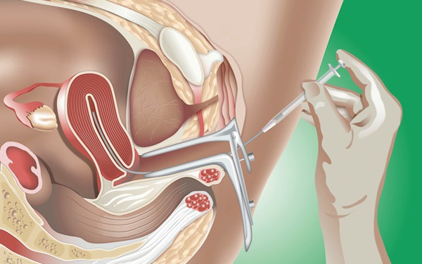 What conditions need to be met to perform intrauterine insemination?
