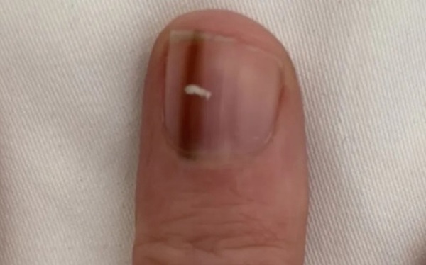 Going to the doctor because of strange marks on her nails, the woman was shocked to find out