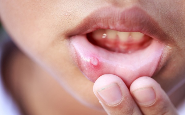 Doctors warn of symptoms that cause oral cancer