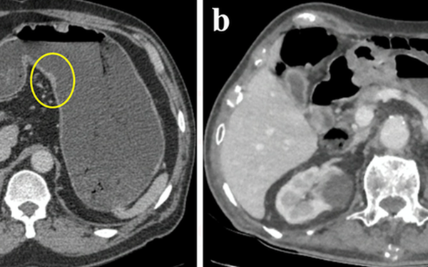 Going to the doctor because of indigestion, suddenly discovered stomach cancer