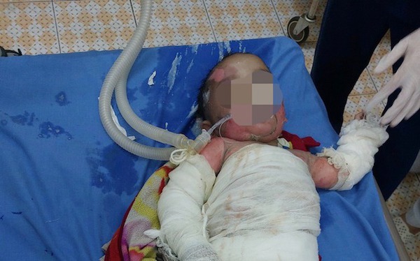 7-month-old baby fell into the fire, burned 40% of the body, the doctor warned how to handle it incorrectly, many people get it