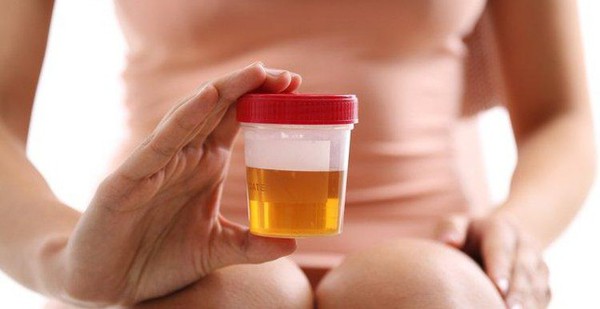 Abnormal urine color is a warning of many dangerous diseases