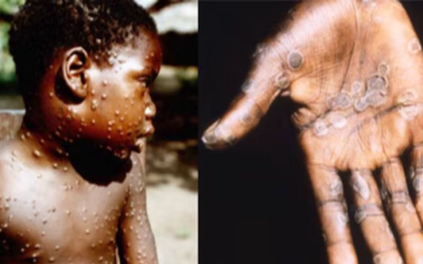 Canada confirms first two cases of monkeypox