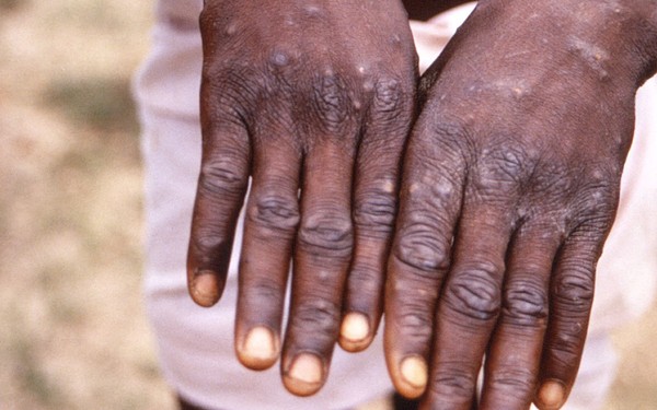 The first European country to issue a regulation to isolate people with monkeypox