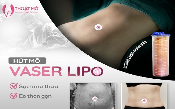 After liposuction, can it be done with other types of surgery?