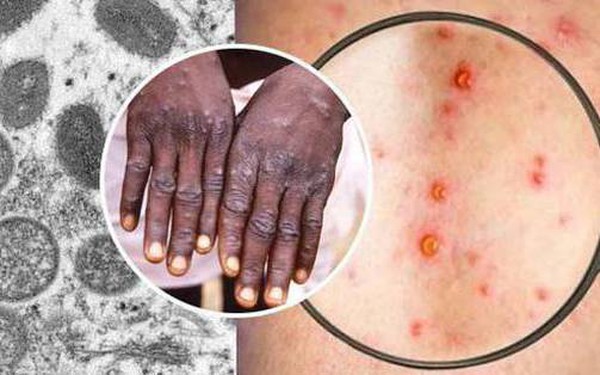 How to prevent monkeypox?