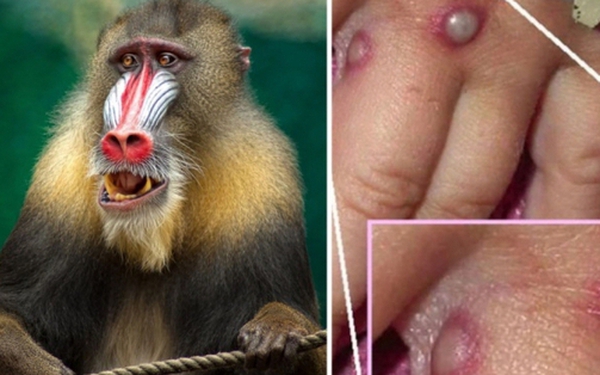2nd Latin American country records first case of monkeypox