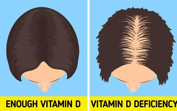 6 dấu hiệu "cảnh báo" cơ thể bạn đang thiếu Vitamin D trầm trọng