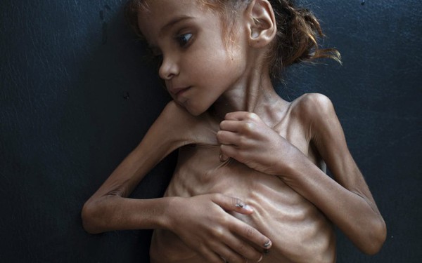 Bé gái trong bức ảnh gây chấn động thế giới về nạn đói đã qua đời, trở thành biểu tượng đau đớn của cuộc khủng hoảng tại Yemen