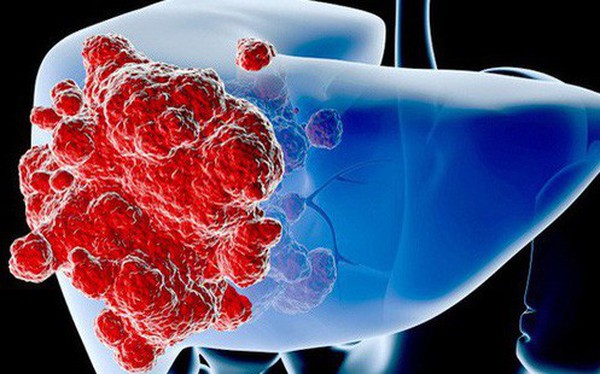 Số người tử vong vì ung thư gan tăng 43% trong 16 năm: Cơ hội sống sót vẫn rất cao nếu nhận biết các dấu hiệu sớm