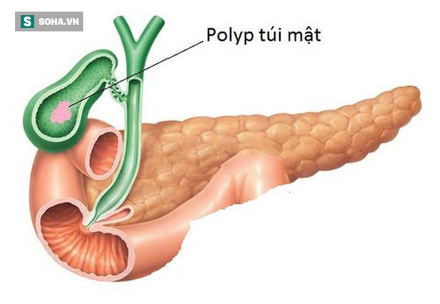  4 thói quen phổ biến có thể khiến bạn bị cắt bỏ túi mật: Ngăn ngừa sỏi và ung thư thế nào? - Ảnh 1.