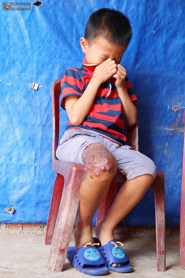 Lời khẩn cầu của bé trai 8 tuổi mắc bệnh lạ, phải cắt bỏ ruột: Mỗi lần chảy máu nó bắn ra ngoài, con sợ lắm… - Ảnh 11.