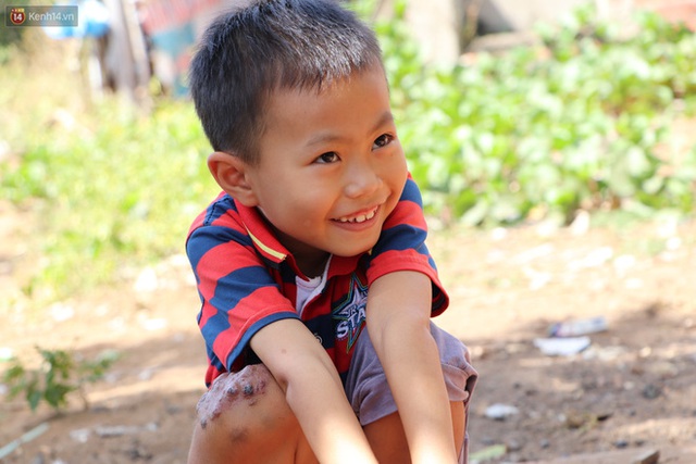 Lời khẩn cầu của bé trai 8 tuổi mắc bệnh lạ, phải cắt bỏ ruột: Mỗi lần chảy máu nó bắn ra ngoài, con sợ lắm… - Ảnh 3. Lời khẩn cầu của bé trai 8 tuổi mắc bệnh lạ, phải cắt bỏ ruột: Mỗi lần chảy máu nó bắn ra ngoài, con sợ lắm… - Ảnh 3.
