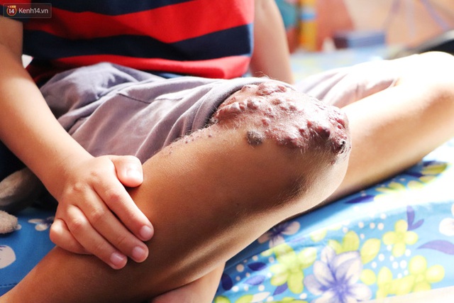 Lời khẩn cầu của bé trai 8 tuổi mắc bệnh lạ, phải cắt bỏ ruột: Mỗi lần chảy máu nó bắn ra ngoài, con sợ lắm… - Ảnh 4. Lời khẩn cầu của bé trai 8 tuổi mắc bệnh lạ, phải cắt bỏ ruột: Mỗi lần chảy máu nó bắn ra ngoài, con sợ lắm… - Ảnh 4.