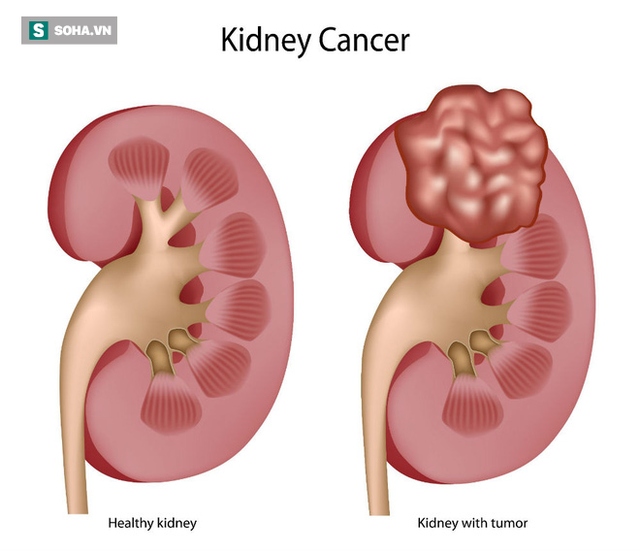  Ung thư thận luôn truy tìm 2 nhóm người: 4 điều hiệu quả giúp bạn trốn thoát án tử - Ảnh 2.