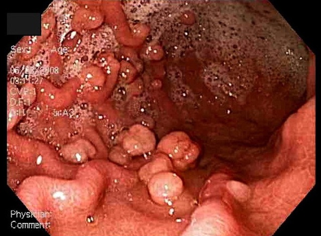  BS BV Đại học Y Dược cảnh báo: 4 yếu tố nguy cơ khiến căn bệnh ung thư dạ dày sớm gõ cửa - Ảnh 1.