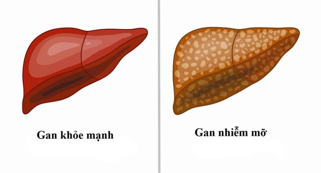 Gan nhiễm mỡ không chỉ do ăn nhiều chất béo: Đây là 4 kẻ thù giấu mặt cần cảnh giác - Ảnh 1. Gan nhiễm mỡ không chỉ do ăn nhiều chất béo: Đây là 4 kẻ thù giấu mặt cần cảnh giác - Ảnh 1.