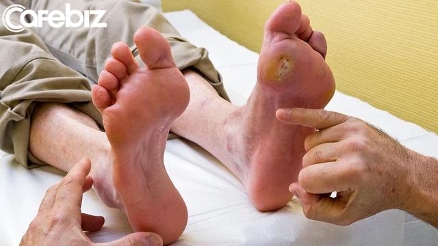 5 dấu hiệu ở bàn chân cảnh báo trọng bệnh, phải đi khám ngay không chừng biến chứng tiểu đường! - Ảnh 2.