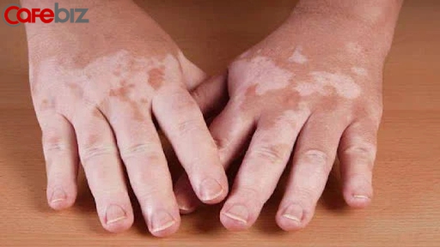 Bệnh tiểu đường được phát hiện qua một nốt mụn? - Ảnh 2. Bệnh tiểu đường được phát hiện qua một nốt mụn? - Ảnh 2.