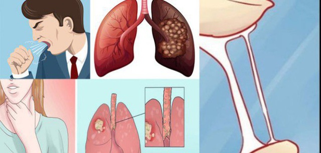 Thường xuyên xuất hiện 4 triệu chứng này thì có thể bạn đã bị ung thư phổi rồi, nhiều người chủ quan với dấu hiệu 3 khiến bệnh nặng thêm - Ảnh 1.