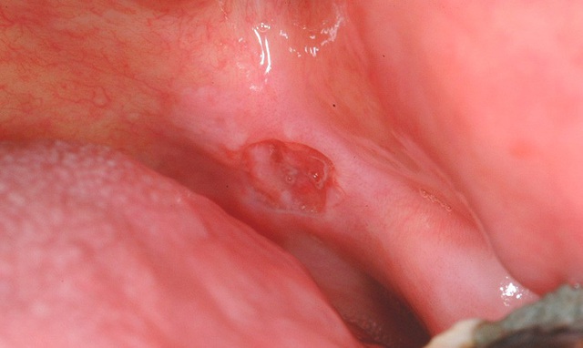  Phân biệt nhiệt miệng và ung thư khoang miệng: 3 gạch đầu dòng quan trọng cần biết - Ảnh 2.