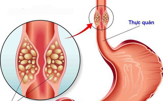  4 bệnh ung thư nguy hiểm nhất do thói quen ăn uống mà ra: Càng chậm thay đổi thì càng dễ mắc - Ảnh 2.