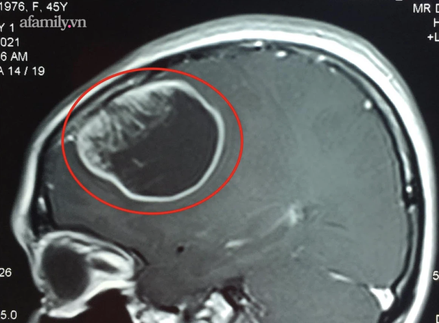 Thường xuyên quên trước quên sau, người phụ nữ tá hỏa phát hiện có khối u to như quả cam trong não - Ảnh 1.