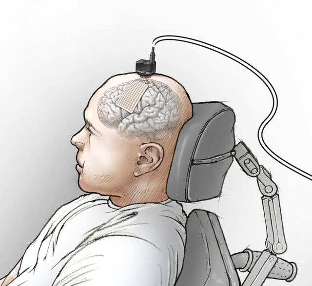 Các nhà khoa học nối não của một người câm với máy tính, và bây giờ anh ấy đã nói được - Ảnh 2. Các nhà khoa học nối não của một người câm với máy tính, và bây giờ anh ấy đã nói được - Ảnh 2.