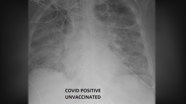  So sánh ảnh chụp phổi của bệnh nhân COVID-19 đã tiêm và chưa tiêm vaccine, phát hiện điều kinh ngạc - Ảnh 1.