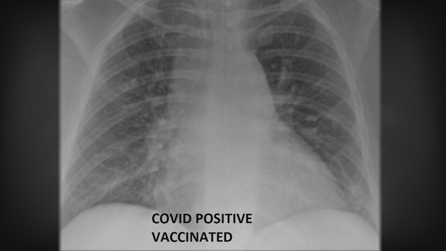  So sánh ảnh chụp phổi của bệnh nhân COVID-19 đã tiêm và chưa tiêm vaccine, phát hiện điều kinh ngạc - Ảnh 2.