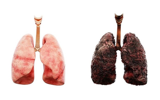 Nghiên cứu mới tìm thấy 3 dạng ung thư phổi ở những người chưa bao giờ hút thuốc, có loại phát sinh sớm tới 10 năm - Ảnh 1.