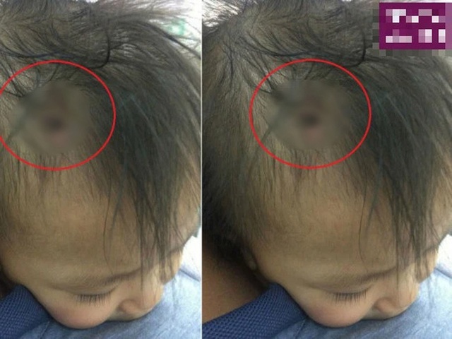 Sự thật về bức ảnh chiếc đinh găm vào đầu cháu bé được cho là nạn nhân nghi án bạo hành ở Hà Nội - Ảnh 2.