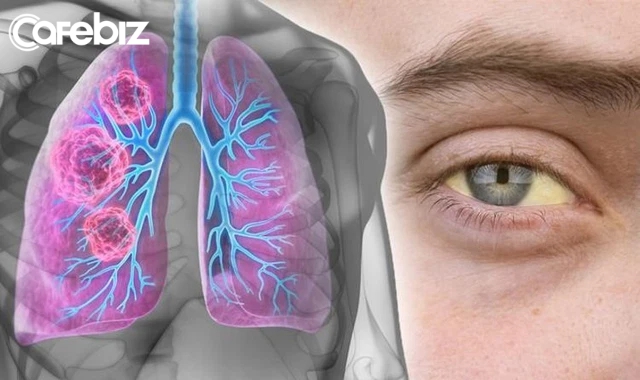 1 dấu hiệu CẤP BÁO của mắt ra hiệu bệnh ung thư phổi giai đoạn cuối - Ảnh 1.