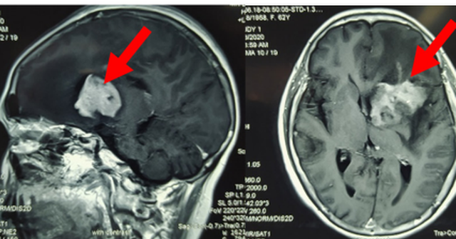 Mũi tên màu đỏ thể hiện não bị tổn thương trên kết quả chụp MRI của người bệnh. (Ảnh: Bệnh viện cung cấp)