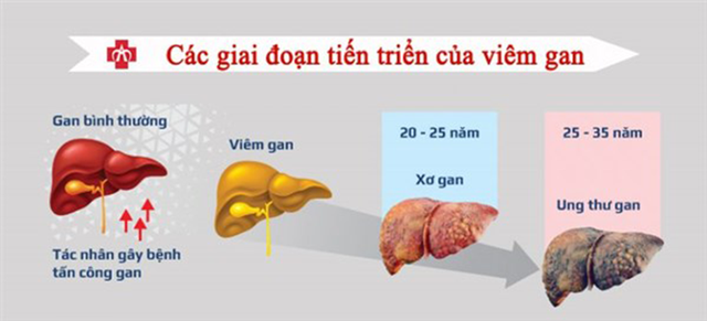   How to prevent liver cancer - Photo 1.