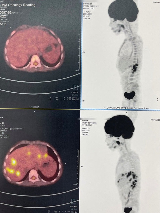 Liver transplant for a 5-year-old patient with serious cancer from a living human liver - Photo 1.