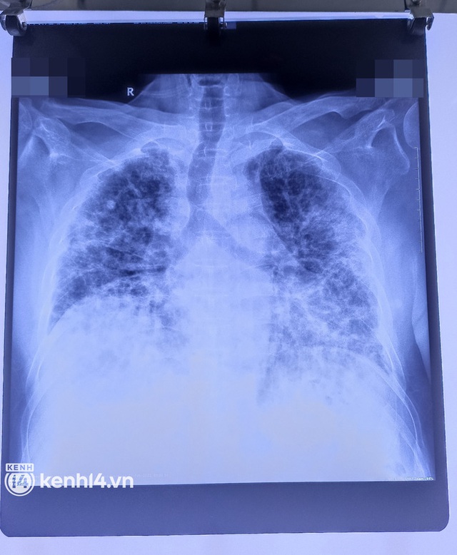 Nhiều người tổn thương nặng, phổi trắng xóa, phải ở bệnh viện 7 tháng ròng để điều trị di chứng hậu Covid-19 - Ảnh 11.