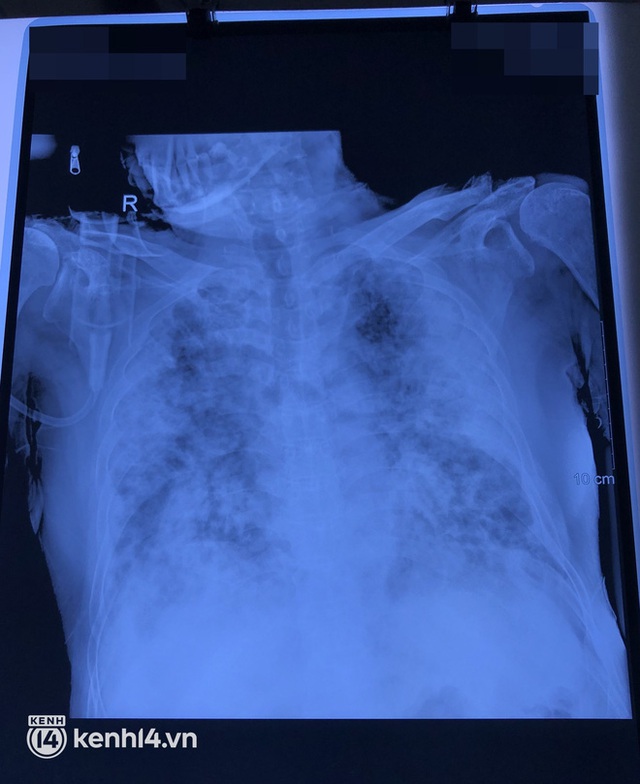 Nhiều người tổn thương nặng, phổi trắng xóa, phải ở bệnh viện 7 tháng ròng để điều trị di chứng hậu Covid-19 - Ảnh 10.