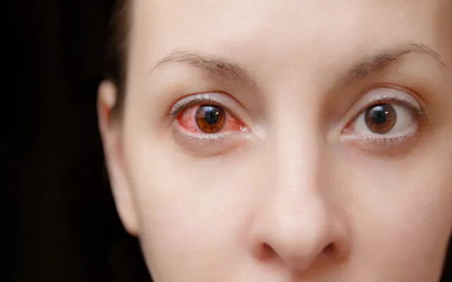 Những bệnh nhiễm trùng mắt liên quan đến COVID - Ảnh 1.