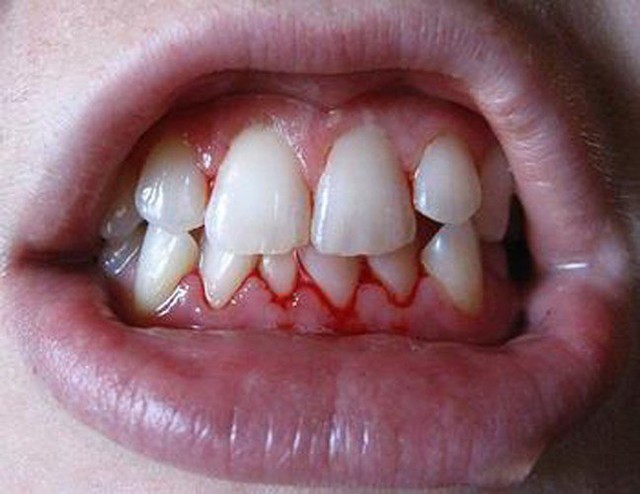 Small signal, do not ignore: Bleeding gums, painful swallowing on the ears, warts can also COMPLEX into cancer, causing 177,000 deaths/year - Photo 2.