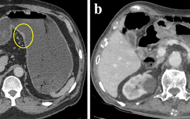 Bên trái: dạ dày được làm căng, khối u nhỏ được phát hiện (trong vòng tròn). Bên phải: dạ dày chưa được làm căng. Ảnh: BVCC