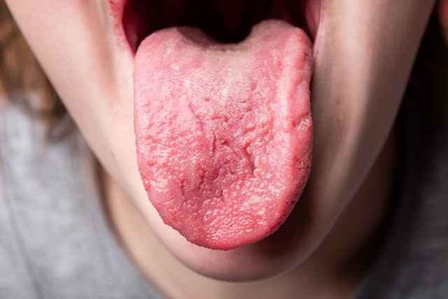 3 signs on the tongue that warn of cardiovascular disease are silently coming to you - Photo 3.