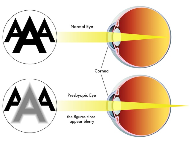 Đã có một loại thuốc nhỏ mắt giúp người già nhìn rõ, không cần đeo kính lão - Ảnh 5.