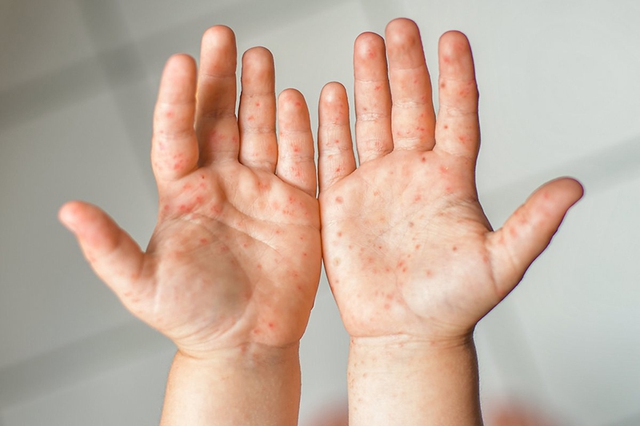 Trẻ mắc bệnh tay chân miệng có được tắm không? Cảnh báo 6 quan niệm sai lầm cha mẹ thường mắc phải khi con bị nhiễm bệnh - Ảnh 3.