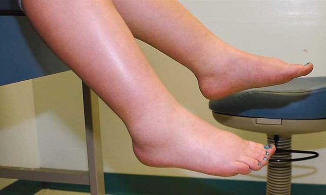 Muốn biết gan tốt hay không chỉ cần nhìn vào bàn chân: Có 6 dấu hiệu này chứng tỏ gan đang bị bệnh - Ảnh 2.