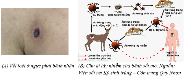 4 ngày xuất hiện nốt ruồi đen trên ngực, người đàn ông bất ngờ sốt cao, phải vào viện cấp cứu vì suy đa tạng, lọc máu liên tục: Cảnh báo căn bệnh dễ gặp khi đi du lịch- Ảnh 1.