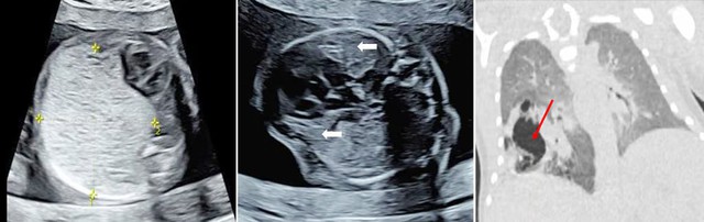 Dùng mũi kim cứu sống thai nhi từ trong bụng mẹ: Đột phá y khoa gây kinh ngạc tại Trung Quốc - Ảnh 1.