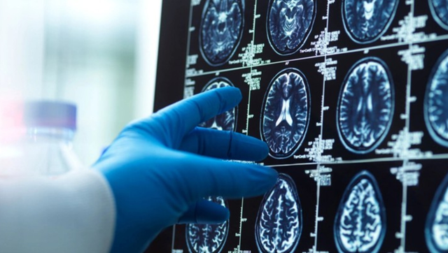 AI lần đầu hỗ trợ mổ não trực tiếp trên người: Cuộc thử nghiệm có thể thay đổi cách bác sĩ phẫu thuật - Ảnh 1.